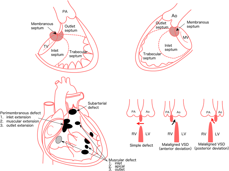 Journal of Pediatric Cardiology and Cardiac Surgery 4(2): 63-74 (2020)