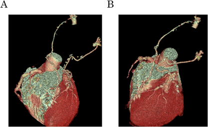 Journal of Pediatric Cardiology and Cardiac Surgery 3(2): 103-107 (2019)
