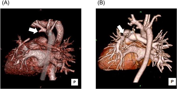 Journal of Pediatric Cardiology and Cardiac Surgery 7(1): 31-35 (2023)