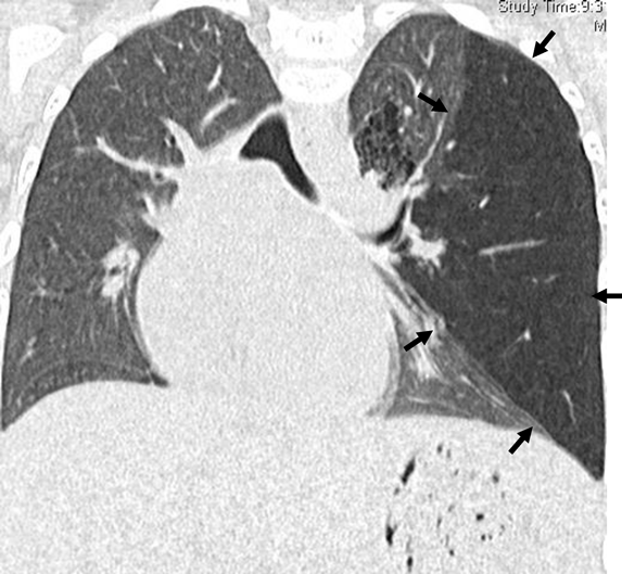 Journal of Pediatric Cardiology and Cardiac Surgery 9(2): 159-161 (2025)